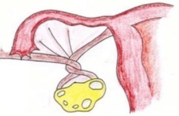Ovarian cysts spiral extremely dangerous, women do not be subjective