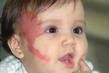 Hematoma do bebê - As marcas de nascença vermelhas são perigosas para o meu bebê?