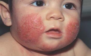 Eczeme pentru sugari - Moduri simple prin care o mamă poate ajuta la eliberarea copilului de disconfort