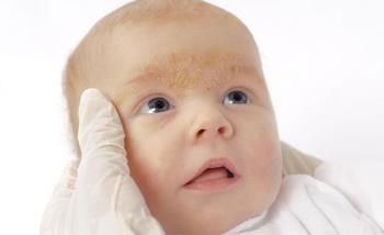 피부염이있는 신생아-자녀를 완전히 치료하기 위해 조기에 인식하는 법을 배웁니다.