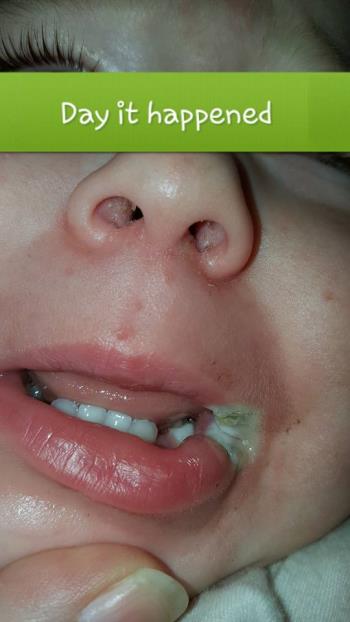 Una ragazza di 19 mesi brucia gravemente, perdendo parte della bocca a causa della ricarica del telefono