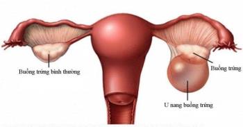 Can pregnancy with ovarian cyst affect the fetus? How to handle?