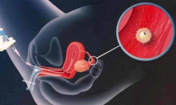 Impara subito a sperimentare il pompaggio dello sperma per aumentare il tasso di gravidanza