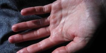 Can rheumatism, sweating hands and feet be treated completely or not?