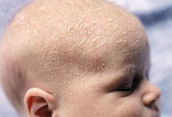 Is the scalp of a newborn baby with white scales due to the mothers wrong hygiene?