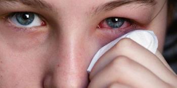Did you know these simple but very effective home remedies for conjunctivitis?