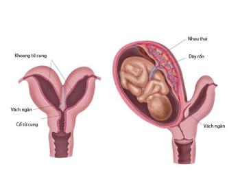 The bipedal uterus directly affects fertility, causing many mothers to worry