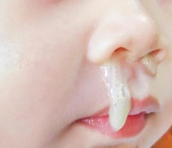 Children with a blue runny nose - How to quickly cure your child