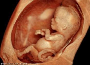 태아의 코뼈 길이가 짧아 아기가 다운에 더 취약하게 태어 났음을 증명합니까?