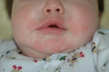 Belirtiler ve hava alerjisi olan bir çocukla nasıl başa çıkılacağı