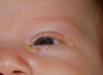 Gli occhi dei bambini sono pizzicati - La causa e il trattamento più accurati