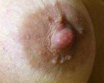 What is a small nodule around the nipple that appears during pregnancy?