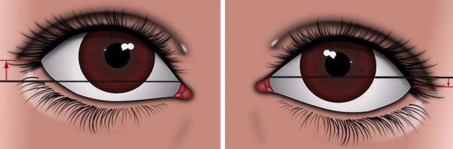 كيفية تشكيل عيون حزينة مترهلة