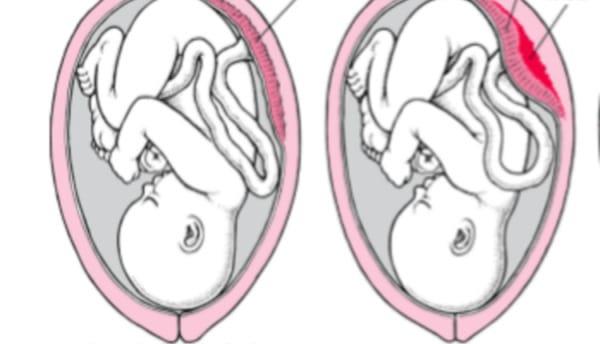 Loslaten van de placenta is buitengewoon gevaarlijk, zwangere moeders mogen niet subjectief zijn!