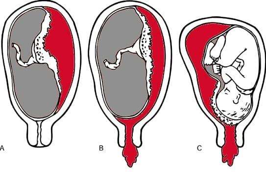 Loslaten van de placenta is buitengewoon gevaarlijk, zwangere moeders mogen niet subjectief zijn!