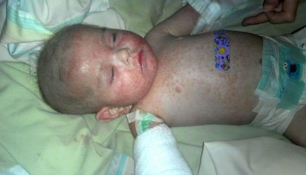 O bebê recém-nascido tem eczema severo e uma história maravilhosa quando uma mãe salva seu bebê das mãos da morte
