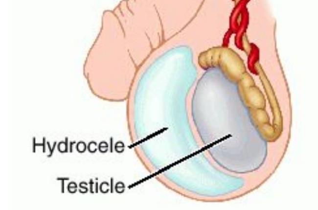 Gros testicules latéraux, petits côtés chez les garçons et ce que les parents doivent savoir!