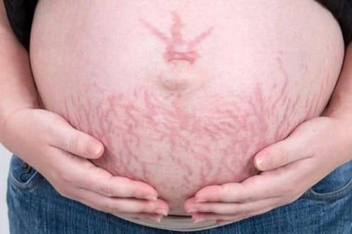 Striae en geen striae tijdens de zwangerschap - Komt het allemaal door de site of eten elkaar om deze 5 redenen?