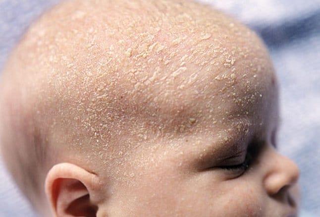 如何照顧新生嬰兒的皮膚，避免出生後第一年最常見的16種皮膚疾病