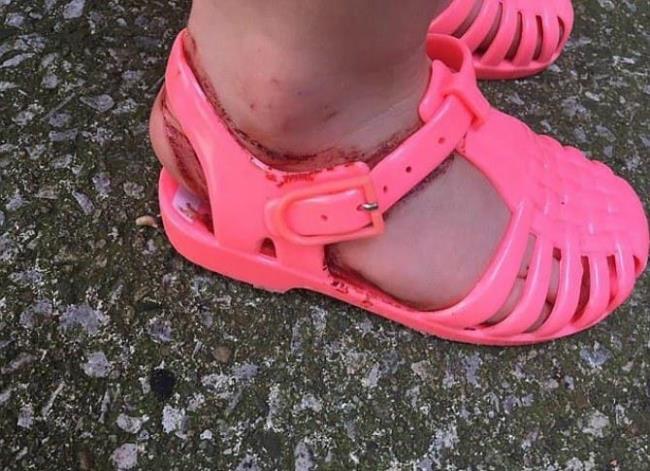 A mãe ficou frustrada quando os sapatos de plástico causaram os ferimentos nas pernas do filho.