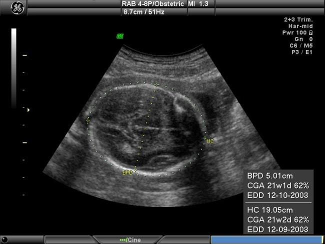 Ultraschallschwangerschaft und 5 wichtige Hinweise Schwangere Mütter müssen sich auf den Ultraschall vorbereiten