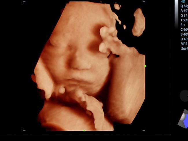 Ultraschallschwangerschaft und 5 wichtige Hinweise Schwangere Mütter müssen sich auf den Ultraschall vorbereiten