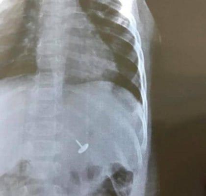 Anak yang dicurigai menelan benda asing, anggota keluarga ketakutan setelah melihat hasil endoskopi
