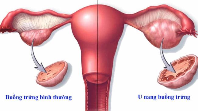 Ovarialzysten: Vorsicht!  Ursachen und Behandlungen