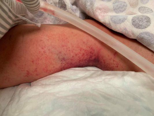 Pensava avesse solo febbre e dolore alle gambe, che si aspettava che il bambino di 4 anni avesse una terribile infezione del sangue