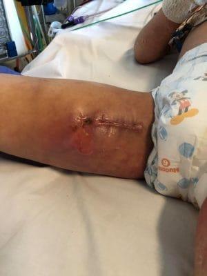 Pensava avesse solo febbre e dolore alle gambe, che si aspettava che il bambino di 4 anni avesse una terribile infezione del sangue