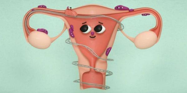 Das Geheimnis zur Schmerzlinderung beim Verlieben in Frauen mit Endometriose