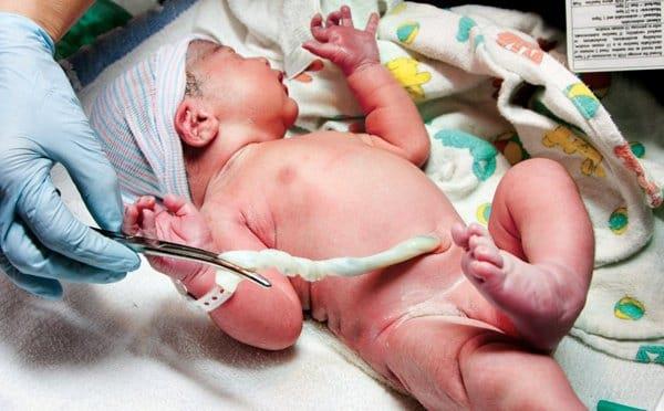 10 cosas que debe saber sobre el almacenamiento de sangre del cordón umbilical para bebés