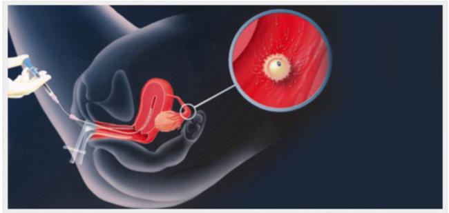 Tasa de natalidad de un hijo con fertilización in vitro - Buenas noticias para los padres