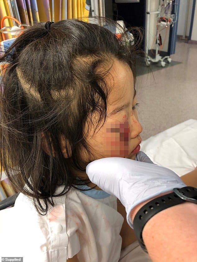 Gadis kecil itu merobek kelopak matanya, hampir buta karena dia terjatuh di gantungan baju di supermarket