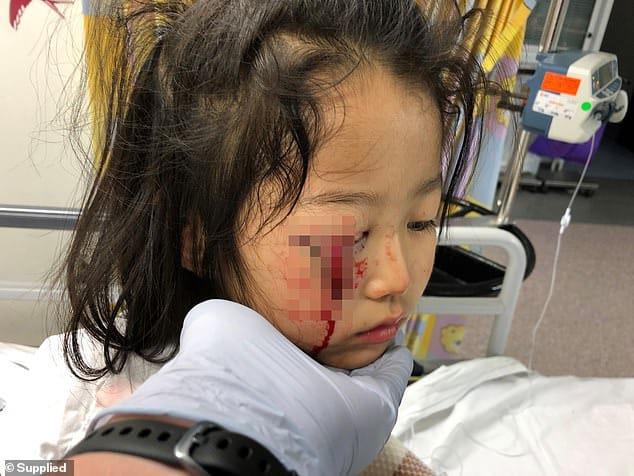 Das kleine Mädchen riss sich die Augenlider und wurde fast blind, weil sie im Supermarkt auf einen Kleiderhaken fiel