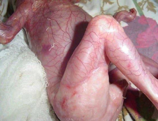 Neugeborene haben aufgrund des schädlichen Fehlers der Mutter während der Schwangerschaft keine Haut