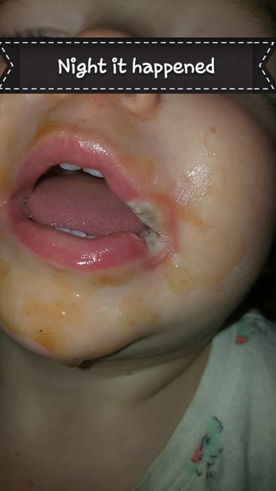 Menina de 19 meses com queimaduras graves, perdendo parte da boca devido ao carregamento do telefone