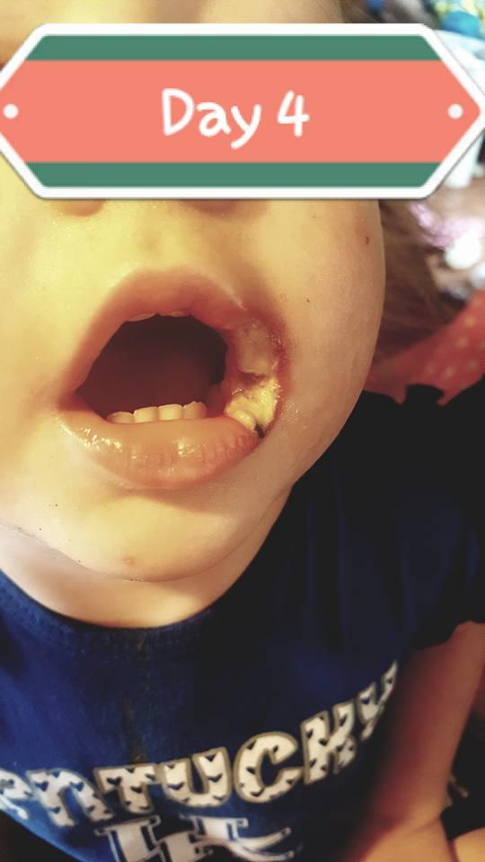 19 개월 된 소녀가 심하게 화상을 입어 전화 충전으로 인해 입의 일부를 잃었습니다.