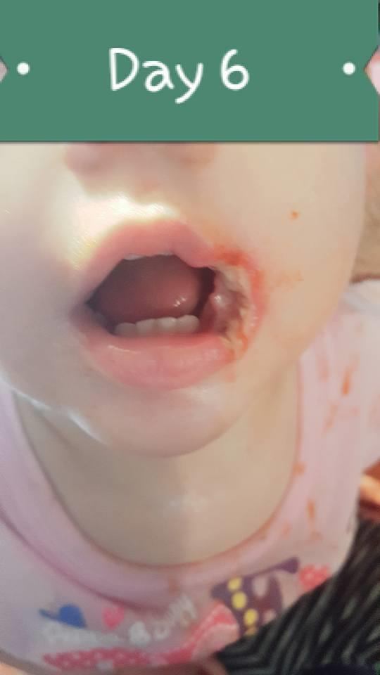 Das 19 Monate alte Mädchen brennt schwer und verliert einen Teil seines Mundes, weil es das Telefon aufgeladen hat
