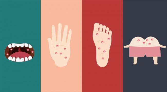 Cara mencegah penyakit tangan, kaki dan mulut - Penyakit ini mudah menimbulkan komplikasi pada anak