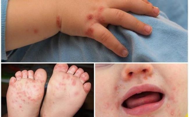 Jak zapobiegać chorobom rąk, pryszczycy - Choroba łatwo powoduje komplikacje u dzieci