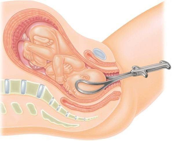Using suction at birth - Risks you may face!