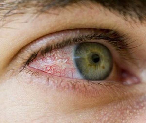 Is conjunctivitis dangerous?  Causes and effective prevention