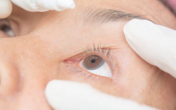 Is conjunctivitis dangerous?  Causes and effective prevention