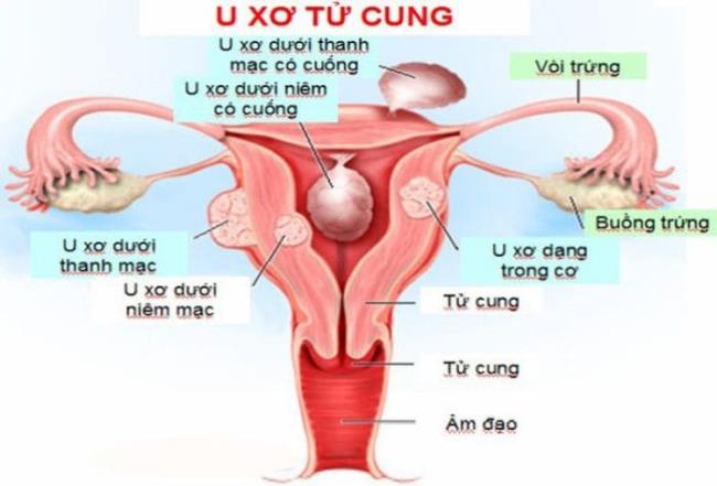 Kann eine Frau mit Uterusfibrose schwanger werden und wie man sie behandelt, um früh ein Baby zu bekommen?