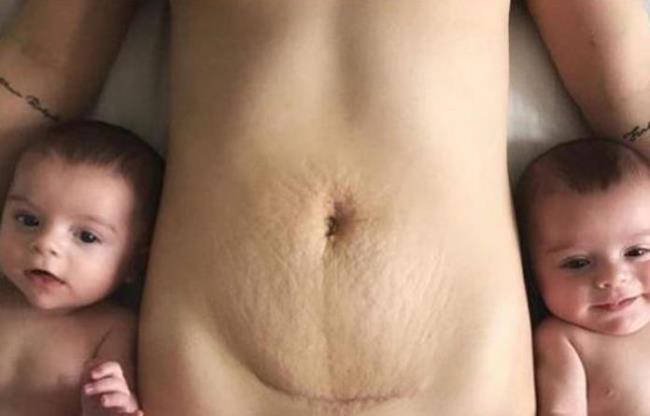 Hard abdomen after cesarean section - What are the causes and treatment?