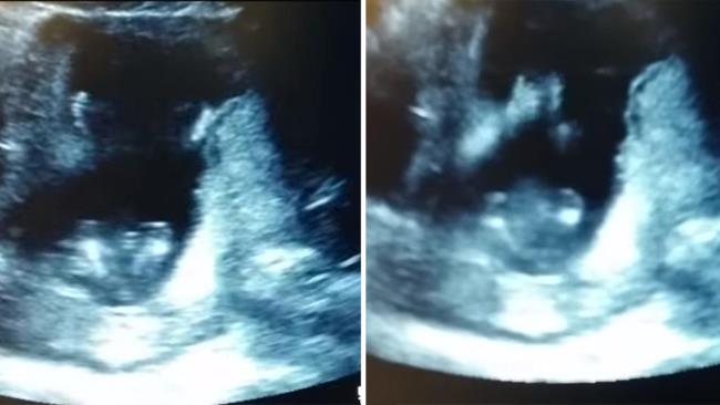 Gambar USG janin - Perhatikan janin bertepuk tangan di dalam rahim
