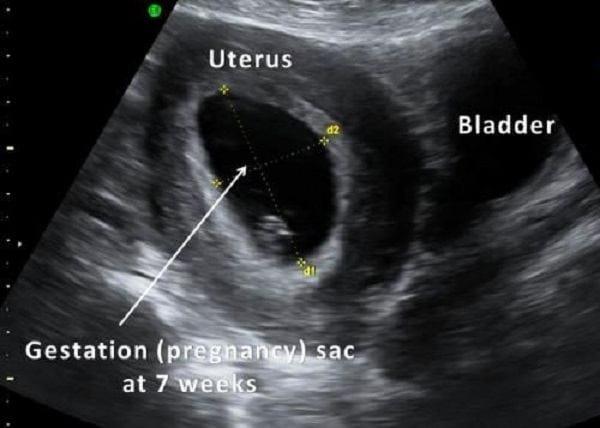 Mamele însărcinate nu trebuie să ignore aceste 4 repere importante cu ultrasunete fetale!