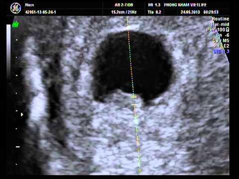 8周大胎兒的照片-尾巴去哪了？