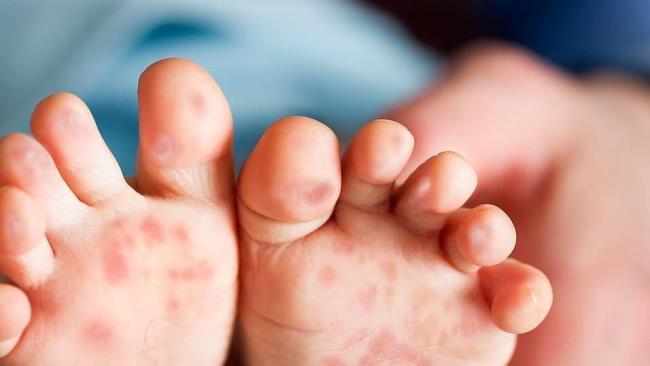 โรคมือเท้าปากในเด็กควรงดอะไร?  ต้องงดลมและน้ำ?